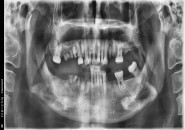 64세 남/ 다수치 발치 및 치조골 이식술 후 임플란트 식립
